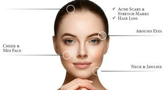 Microneedling: The Tiny Needles Behind Radiant Skin